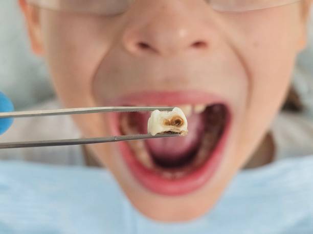 Best Emergency Treatment for Oral Infections in Roselle Park, NJ